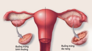 Khả năng thụ thai có liên quan đến kích thước buồng trứng không?