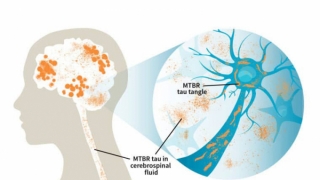 Kiểm tra giai đoạn bệnh Alzheimer qua protein trong tủy bệnh nhân