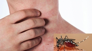 Sốt Chikungunya do muỗi đốt gây ra là bệnh gì? Bệnh này khác gì so với sốt xuất huyết?