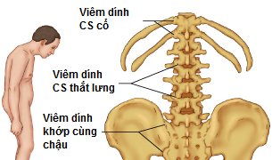 Làm thế nào để sống khỏe mạnh cùng bệnh viêm cột sống dính khớp?