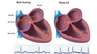 Uống nhiều rượu sẽ làm tăng biến cố bất lợi ở bệnh nhân rung nhĩ