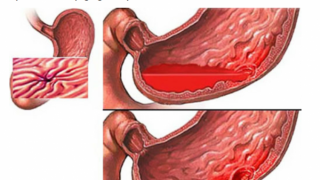 Cứu người bệnh bị xuất huyết tiêu hóa