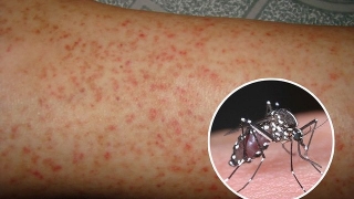 Sốt xuất huyết Dengue là bệnh gì? Có nguy hiểm hay không?