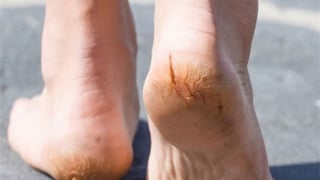 Mách bạn một số cách chữa nứt gót chân mùa mùa lạnh đơn giản tại nhà