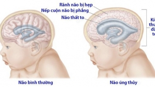 Biến chứng chết người của não úng thủy