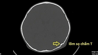 Bé trai lõm sọ do ngã xe đạp
