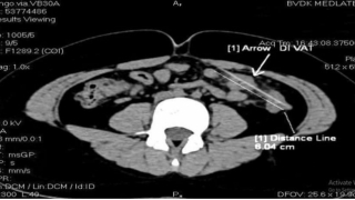 Thủng ruột sau khi ăn ốc, “thủ phạm” là thói quen nhiều người Việt mắc phải