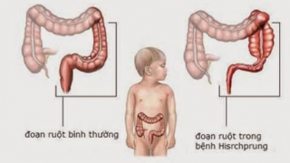 Tắc ruột bẩm sinh làm thế nào để điều trị?