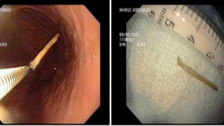 Phẫu thuật lấy cây tăm mắc vào dạ dày bệnh nhân