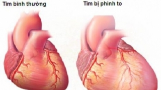 Bệnh tim to là gì? Có nguy hiểm hay không?