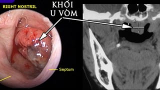 Ù tai kéo dài có thể là dấu hiệu của ung thư vòm họng