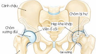 Thoái hóa khớp háng có thể gây tàn phế