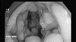 Hàng trăm polyp chen chúc trong đại trực tràng hai anh em 44 tuổi và 31 tuổi