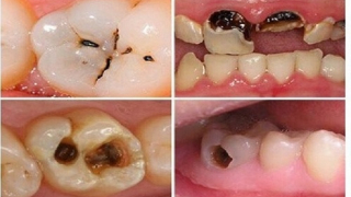 Sâu răng có thể làm tăng nguy cơ xuất huyết não