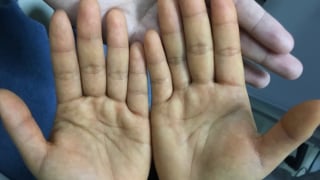 Ăn quá nhiều đu đủ, cô gái da vàng như nghệ
