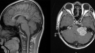 Thanh niên bị lác mắt do khối u màng não