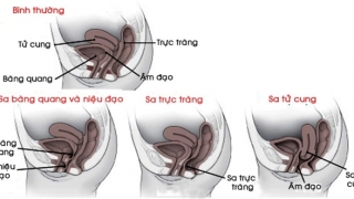 Cảnh báo sa vùng tạng chậu ở phụ nữ trung niên