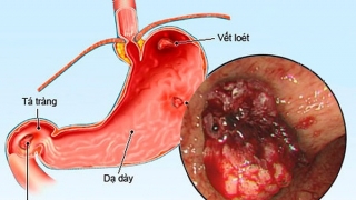 Dấu hiệu bệnh viêm loét dạ dày tá tràng mọi người nên chú ý