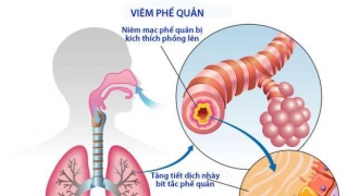 Chanh - thuốc chống viêm, giảm ho