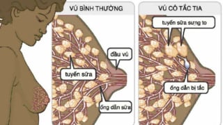 Cách chữa tắc tia sữa