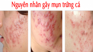 Nguyên nhân gây mụn trứng cá