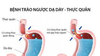 Trào ngược dạ dày thực quản ở trẻ sơ sinh