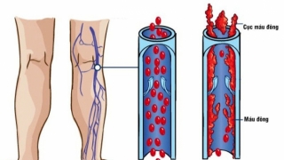 Cách phòng ngừa Huyết khối tĩnh mạch sâu