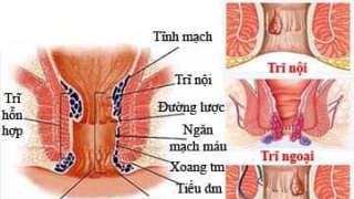 Một phụ nữ bị nhiễm trùng nặng do cắt trĩ tại Spa