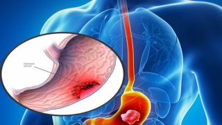 Ung thư dạ dày là một trong những loại ung thư nguy hiểm nhất