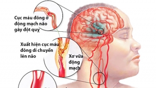 Những lưu ý quan trọng về bệnh xơ vữa động mạch