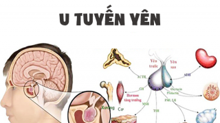 Một số lưu ý quan trọng về bệnh u tuyến yên