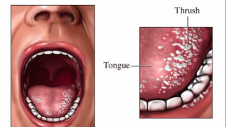 Những điều cần biết về căn bệnh nấm đường tiêu hóa