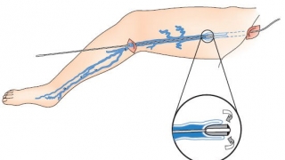 Những dấu hiệu để nhận biết bệnh suy giãn tĩnh mạch chi dưới