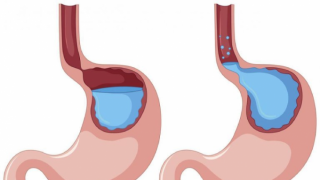 Những điều cần biết về bệnh trào ngược dạ dày