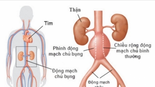 Phình động mạch chủ có tỷ lệ tử vong rất cao