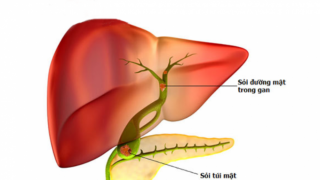 Cách để dự phòng sỏi đường mật trong gan