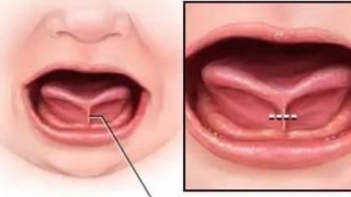 Dị tật bẩm sinh do hãm lưỡi