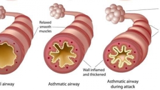 Vì sao cơn hen phế quản thường xảy ra về đêm?