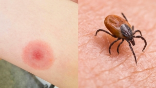 Phát hiện ra cơ chế tạo kháng thể ở người mắc bệnh Lyme