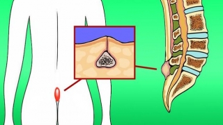 Bệnh pilonidal có xu hướng ảnh hưởng đến giới trẻ