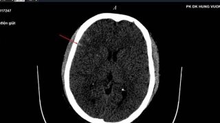 Phú Thọ cấp cứu bệnh nhân bị điện giật tụ máu não