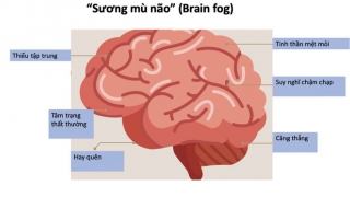 Biểu hiện của triệu chứng “sương mù não” hậu COVID-19