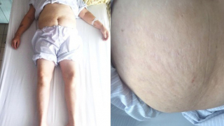 Quảng Ninh tiếp nhận nhiều trường hợp là nạn nhân của việc lạm dụng corticoid