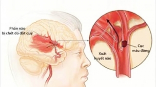 Những điều cần đặc biệt lưu ý về bệnh đột quỵ