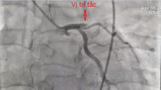 Hà Nội cấp cứu một bệnh nhân bị ngừng tim đột ngột