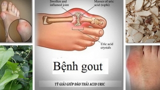 Thuốc và món ăn hỗ trợ trị bệnh gout