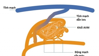 Cảnh báo dị dạng thông động tĩnh mạch não