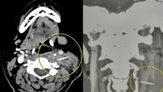Thanh Hóa: Lấy xương cá đâm xuyên qua thành họng, gây ổ áp xe ở cổ bệnh nhân