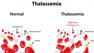 Ngày Thalassemia Thế giới 8/5/2022: Cách phòng căn bệnh di truyền có tỷ lệ cao nhất trên thế giới