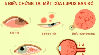 Bệnh lupus ban đỏ ảnh hưởng rất nhiều đến mắt